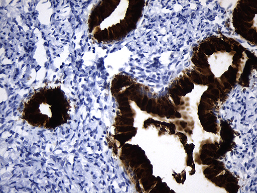 NR5A1 / SF1 Antibody - Immunohistochemical staining of paraffin-embedded cervical carcinoma tissue using anti-NR5A1 mouse monoclonal antibody. (Heat-induced epitope retrieval by 1mM EDTA in 10mM Tris buffer. (pH8.0) at 120°C for 3 min. (1:200)