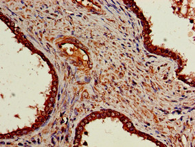 NR5A2 / LRH-1 Antibody - Immunohistochemistry of paraffin-embedded human prostate cancer using NR5A2 Antibody at dilution of 1:100