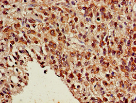 NR5A2 / LRH-1 Antibody - Immunohistochemistry of paraffin-embedded human glioma cancer using NR5A2 Antibody at dilution of 1:100