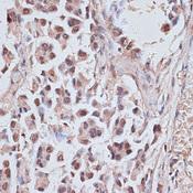 NR5A2 / LRH-1 Antibody - Immunohistochemistry of paraffin-embedded Human lung cancer using NR5A2 Polyclonal Antibody at dilution of 1:100 (40x lens).