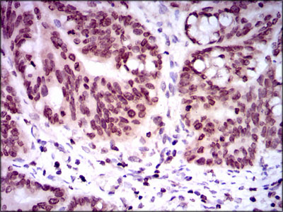 NR6A1 / GCNF Antibody - IHC of paraffin-embedded rectum cancer tissues using NR6A1 mouse monoclonal antibody with DAB staining.