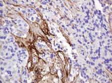 NRAS / N-ras Antibody - IHC of paraffin-embedded Adenocarcinoma of Human colon tissue using anti-NRAS mouse monoclonal antibody.