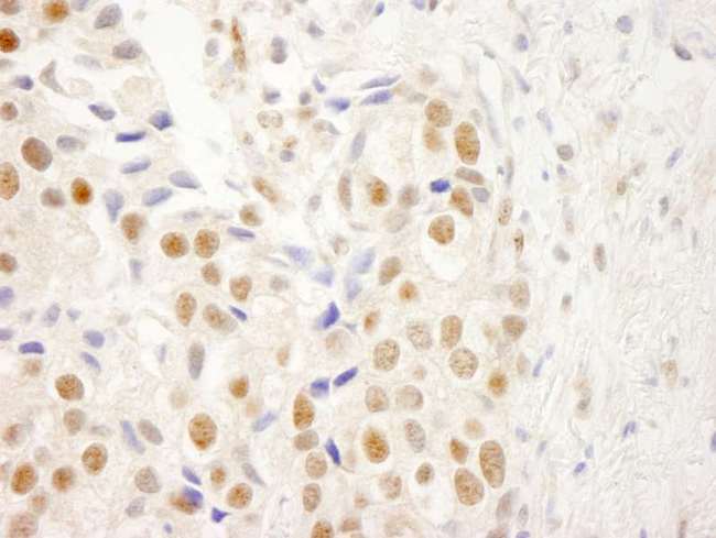 NRBF2 Antibody - Detection of Human NRBF2 by Immunohistochemistry. Sample: FFPE section of human breast carcinoma. Antibody: Affinity purified rabbit anti-NRBF2 used at a dilution of 1:250.