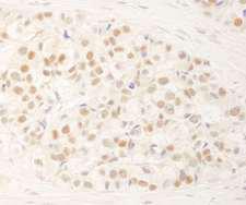 NRBF2 Antibody - Detection of Human NRBF2 by Immunohistochemistry. Sample: FFPE section of human breast carcinoma. Antibody: Affinity purified rabbit anti-NRBF2 used at a dilution of 1:1000 (1 ug/ml). Detection: DAB.