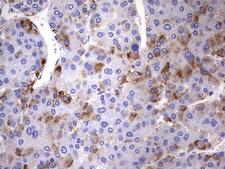 NRBF2 Antibody - IHC of paraffin-embedded Carcinoma of Human liver tissue using anti-NRBF2 mouse monoclonal antibody. (Heat-induced epitope retrieval by 1 mM EDTA in 10mM Tris, pH8.5, 120°C for 3min).