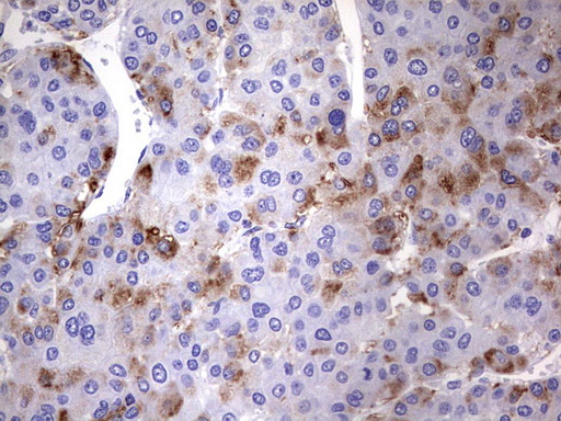 NRBF2 Antibody - IHC of paraffin-embedded Carcinoma of Human liver tissue using anti-NRBF2 mouse monoclonal antibody. (Heat-induced epitope retrieval by 1 mM EDTA in 10mM Tris, pH8.5, 120°C for 3min).