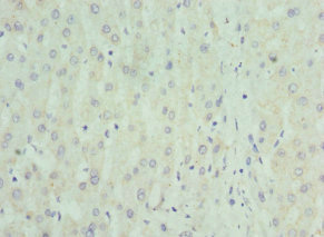 NRBF2 Antibody - Immunohistochemistry of paraffin-embedded human liver cancer at dilution 1:100