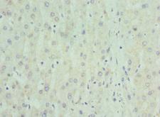 NRBF2 Antibody - Immunohistochemistry of paraffin-embedded human liver cancer at dilution 1:100