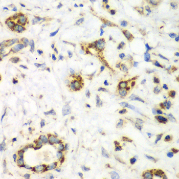 NRBF2 Antibody - Immunohistochemistry of paraffin-embedded human liver cancer using NRBF2 antibody at dilution of 1:100 (40x lens).