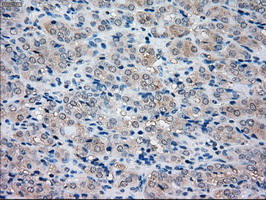 NRBP1 / NRBP Antibody - IHC of paraffin-embedded Carcinoma of thyroid tissue using anti-NRBP1 mouse monoclonal antibody. (Dilution 1:50).
