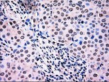 NRBP1 / NRBP Antibody - IHC of paraffin-embedded Adenocarcinoma of breast tissue using anti-NRBP1 mouse monoclonal antibody. (Dilution 1:50).