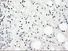NRBP1 / NRBP Antibody - Immunohistochemical staining of paraffin-embedded Carcinoma of pancreas tissue using anti-NRBP1 mouse monoclonal antibody. (Dilution 1:50).