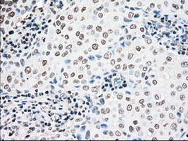 NRBP1 / NRBP Antibody - Immunohistochemical staining of paraffin-embedded Adenocarcinoma of breast tissue using anti-NRBP1 mouse monoclonal antibody. (Dilution 1:50).