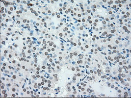 NRBP1 / NRBP Antibody - Immunohistochemical staining of paraffin-embedded Carcinoma of thyroid tissue using anti-NRBP1 mouse monoclonal antibody. (Dilution 1:50).