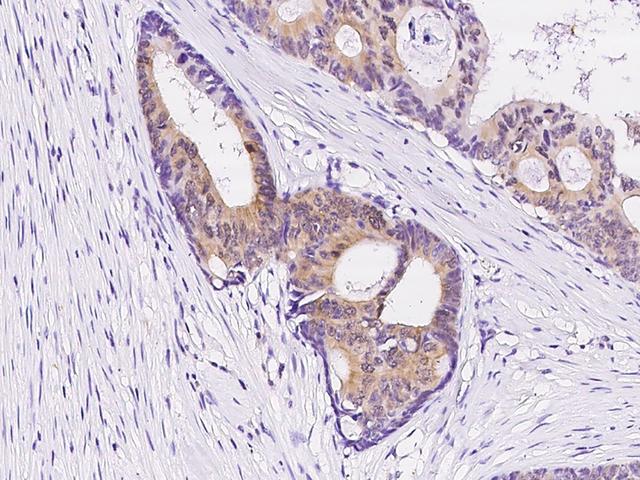 NRBP2 Antibody - Immunochemical staining of human NRBP2 in human colon carcinoma with rabbit polyclonal antibody at 1:300 dilution, formalin-fixed paraffin embedded sections.