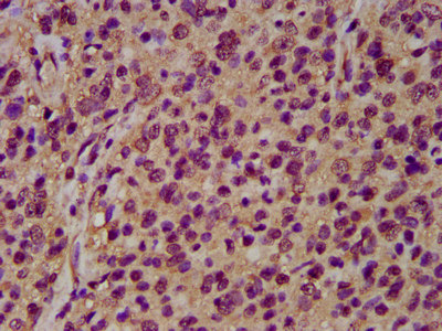 NRCAM Antibody - Immunohistochemistry image at a dilution of 1:200 and staining in paraffin-embedded human glioma cancer performed on a Leica BondTM system. After dewaxing and hydration, antigen retrieval was mediated by high pressure in a citrate buffer (pH 6.0) . Section was blocked with 10% normal goat serum 30min at RT. Then primary antibody (1% BSA) was incubated at 4 °C overnight. The primary is detected by a biotinylated secondary antibody and visualized using an HRP conjugated SP system.