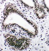 NRF1 / NRF-1 Antibody - NRF1 / NRF-1 antibody. IHC(P): Human Breast Cancer Tissue.