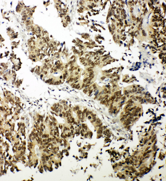 NRF1 / NRF-1 Antibody - NRF1 / NRF-1 antibody. IHC(P): Human Intestinal Cance Tissue.