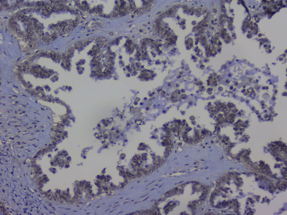 NRF1 / NRF-1 Antibody - IHC analysis of NRF1 using anti-NRF1 antibody. NRF1 was detected in paraffin-embedded section of human ovary cancer tissue. Heat mediated antigen retrieval was performed in citrate buffer (pH6, epitope retrieval solution) for 20 mins. The tissue section was blocked with 10% goat serum. The tissue section was then incubated with 1µg/ml rabbit anti-NRF1 Antibody overnight at 4°C. Biotinylated goat anti-rabbit IgG was used as secondary antibody and incubated for 30 minutes at 37°C. The tissue section was developed using Strepavidin-Biotin-Complex (SABC) with DAB as the chromogen.