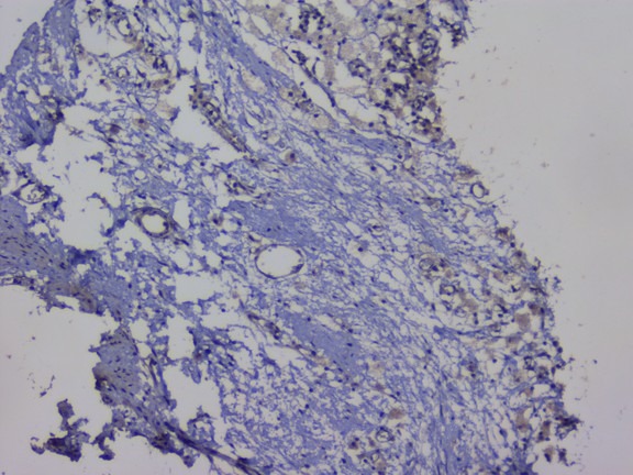 NRF1 / NRF-1 Antibody - IHC analysis of NRF1 using anti-NRF1 antibody. NRF1 was detected in paraffin-embedded section of human appendicitis tissue. Heat mediated antigen retrieval was performed in citrate buffer (pH6, epitope retrieval solution) for 20 mins. The tissue section was blocked with 10% goat serum. The tissue section was then incubated with 1µg/ml rabbit anti-NRF1 Antibody overnight at 4°C. Biotinylated goat anti-rabbit IgG was used as secondary antibody and incubated for 30 minutes at 37°C. The tissue section was developed using Strepavidin-Biotin-Complex (SABC) with DAB as the chromogen.