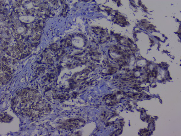 NRF1 / NRF-1 Antibody - IHC analysis of NRF1 using anti-NRF1 antibody. NRF1 was detected in paraffin-embedded section of human gastric cancer tissue. Heat mediated antigen retrieval was performed in citrate buffer (pH6, epitope retrieval solution) for 20 mins. The tissue section was blocked with 10% goat serum. The tissue section was then incubated with 1µg/ml rabbit anti-NRF1 Antibody overnight at 4°C. Biotinylated goat anti-rabbit IgG was used as secondary antibody and incubated for 30 minutes at 37°C. The tissue section was developed using Strepavidin-Biotin-Complex (SABC) with DAB as the chromogen.