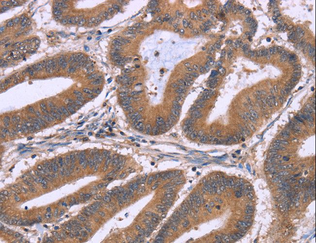 NRG1 / Heregulin / Neuregulin Antibody - Immunohistochemistry of paraffin-embedded Human colon cancer using NRG1 Polyclonal Antibody at dilution of 1:40.