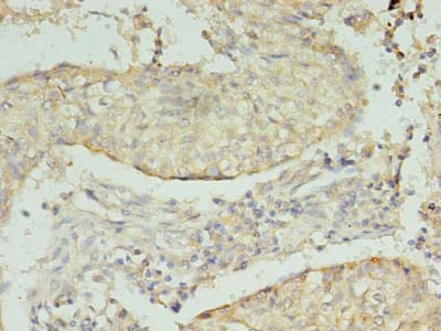 NRG2 Antibody - Immunohistochemistry of paraffin-embedded human lung cancer using antibody at dilution of 1:100.