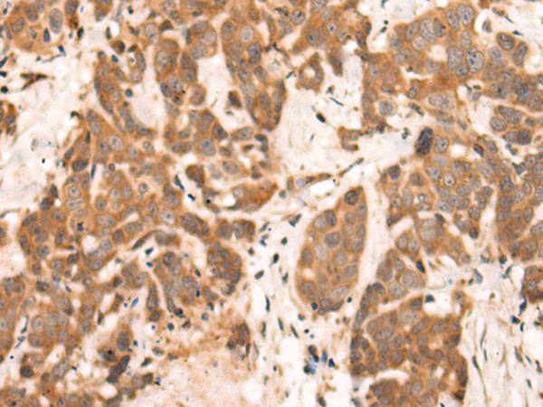 NRG2 Antibody - Immunohistochemistry of paraffin-embedded Human thyroid cancer tissue  using NRG2 Polyclonal Antibody at dilution of 1:65(×200)
