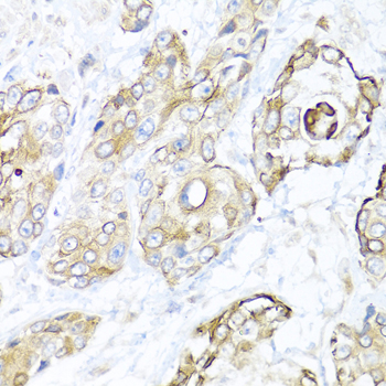 NRG4 Antibody - Immunohistochemistry of paraffin-embedded human prostate cancer tissue.