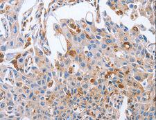 NRG4 Antibody - Immunohistochemistry of paraffin-embedded Human cervical cancer using NRG4 Polyclonal Antibody at dilution of 1:60.