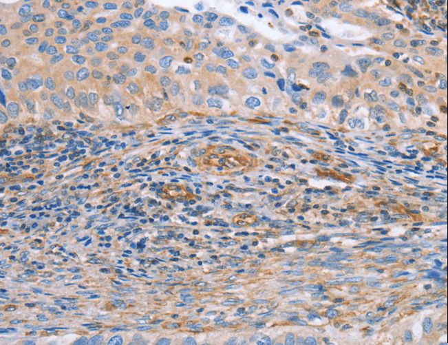 NRG4 Antibody - Immunohistochemistry of paraffin-embedded Human cervical cancer using NRG4 Polyclonal Antibody at dilution of 1:60.