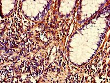 NRIP2 Antibody - Immunohistochemistry of paraffin-embedded human colon cancer using NRIP2 Antibody at dilution of 1:100