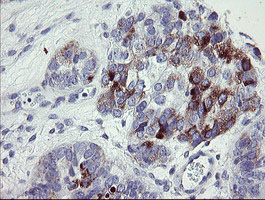 NRIP3 Antibody - IHC of paraffin-embedded Adenocarcinoma of Human ovary tissue using anti-NRIP3 mouse monoclonal antibody. (Heat-induced epitope retrieval by 10mM citric buffer, pH6.0, 100C for 10min).