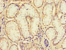NRIP3 Antibody - Immunohistochemistry of paraffin-embedded human gastric cancer using NRIP3 Antibody at dilution of 1:100