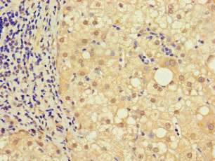 NRIP3 Antibody - Immunohistochemistry of paraffin-embedded human liver cancer using NRIP3 Antibody at dilution of 1:100
