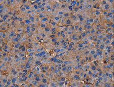 NRIP3 Antibody - Immunohistochemistry of paraffin-embedded Human liver cancer using NRIP3 Polyclonal Antibody at dilution of 1:60.