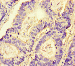 NRP2 / Neuropilin 2 Antibody - Immunohistochemistry of paraffin-embedded human colon cancer at dilution of 1:100