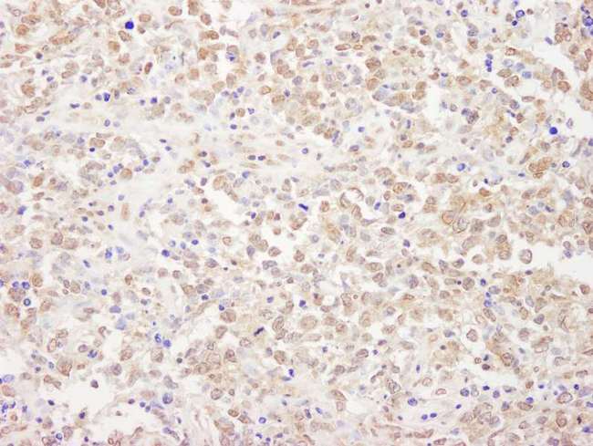 NRSF / REST Antibody - Detection of Human REST by Immunohistochemistry. Sample: FFPE section of human metastatic lymph node. Antibody: Affinity purified rabbit anti-REST used at a dilution of 1:1000 (1 ug/ml). Detection: DAB.