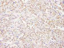 NRSF / REST Antibody - Detection of Human REST by Immunohistochemistry. Sample: FFPE section of human metastatic lymph node. Antibody: Affinity purified rabbit anti-REST used at a dilution of 1:1000 (1 ug/ml). Detection: DAB.