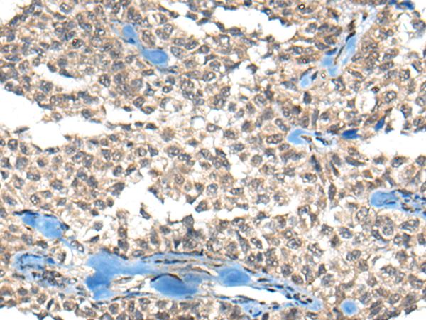 NRSF / REST Antibody - Immunohistochemistry of paraffin-embedded Human ovarian cancer tissue  using REST Polyclonal Antibody at dilution of 1:50(×200)