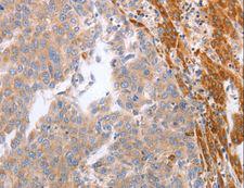 NRTN / Neurturin Antibody - Immunohistochemistry of paraffin-embedded Human breast cancer using NRTN Polyclonal Antibody at dilution of 1:60.