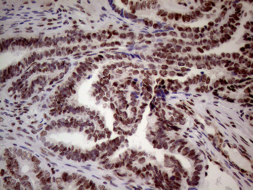 NSD3 / WHSC1L1 Antibody - Immunohistochemical staining of paraffin-embedded Adenocarcinoma of Human endometrium tissue using anti-WHSC1L1 mouse monoclonal antibody. (Heat-induced epitope retrieval by 1mM EDTA in 10mM Tris buffer. (pH8.5) at 120°C for 3 min. (1:500)