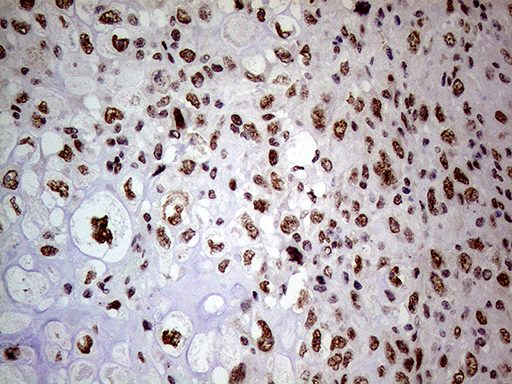 NSD3 / WHSC1L1 Antibody - Immunohistochemical staining of paraffin-embedded Adenocarcinoma of Human breast tissue tissue using anti-WHSC1L1 mouse monoclonal antibody. (Heat-induced epitope retrieval by 1mM EDTA in 10mM Tris buffer. (pH8.5) at 120°C for 3 min. (1:500)