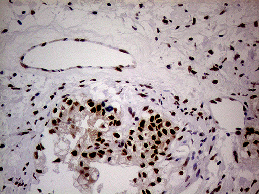 NSD3 / WHSC1L1 Antibody - Immunohistochemical staining of paraffin-embedded Adenocarcinoma of Human ovary tissue using anti-WHSC1L1 mouse monoclonal antibody. (Heat-induced epitope retrieval by 1mM EDTA in 10mM Tris buffer. (pH8.5) at 120°C for 3 min. (1:500)