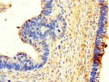 NSD3 / WHSC1L1 Antibody - Immunohistochemistry of paraffin-embedded human ovarian cancer using WHSC1L1 Antibody at dilution of 1:100