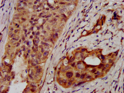 NSDHL Antibody - Immunohistochemistry image at a dilution of 1:400 and staining in paraffin-embedded human cervical cancer performed on a Leica BondTM system. After dewaxing and hydration, antigen retrieval was mediated by high pressure in a citrate buffer (pH 6.0) . Section was blocked with 10% normal goat serum 30min at RT. Then primary antibody (1% BSA) was incubated at 4 °C overnight. The primary is detected by a biotinylated secondary antibody and visualized using an HRP conjugated SP system.