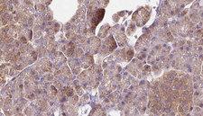 NSDHL Antibody - 1:100 staining human pancreas carcinoma tissue by IHC-P. The sample was formaldehyde fixed and a heat mediated antigen retrieval step in citrate buffer was performed. The sample was then blocked and incubated with the antibody for 1.5 hours at 22°C. An HRP conjugated goat anti-rabbit antibody was used as the secondary.