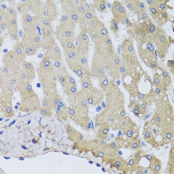 NSF Antibody - Immunohistochemistry of paraffin-embedded human liver injury using NSF antibodyat dilution of 1:100 (40x lens).