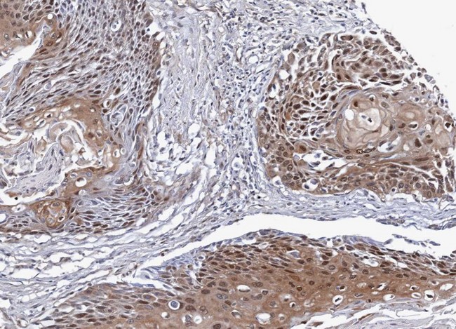 NSFL1C Antibody - IHC of paraffin-embedded differential N/T pair Lung SCC cancer xenograft using NSFL1C antibody at 1:100 dilution.