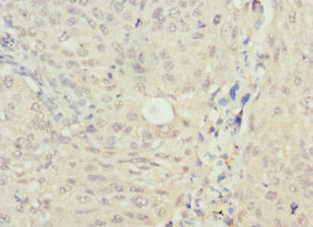 NSFL1C Antibody - Immunohistochemistry of paraffin-embedded human lung cancer at dilution 1:100
